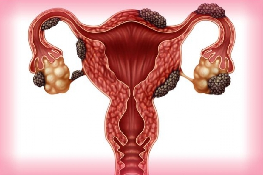 (w882) endometrio