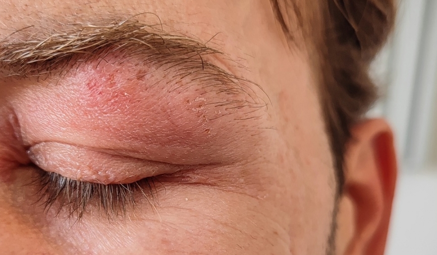 (P) Alergiile de vară și ochii tăi – când disconfortul ocular poate fi mai mult decât o simplă iritație