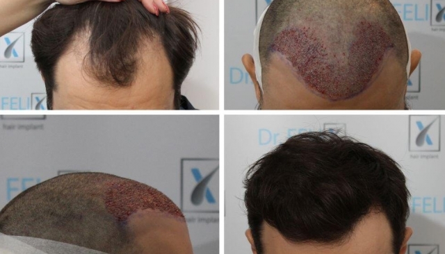 (P) Căderea părului este o frustrare? Rezolvă problema la Dr. Felix Hair Implant
