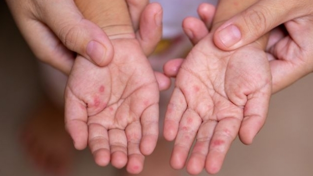 Ce face dezinformarea: România, pe primul loc în UE la îmbolnăvirile și decesele de rujeolă. Românii se mai gândesc dacă își vaccinează copiii