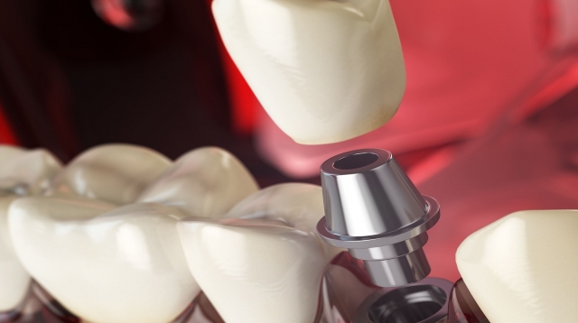 (P) Cui i se recomandă tratamentul All-on-6? Indicații și criterii