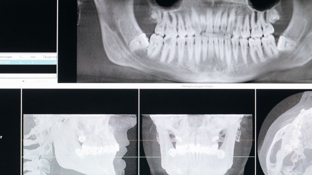 (P) Tipuri de implant dentar: cum se alege sistemul potrivit